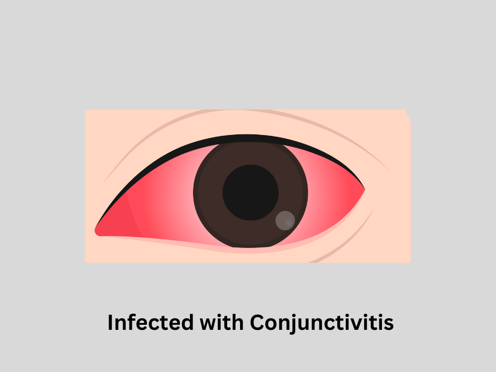 an eye infected with Conjunctivitis